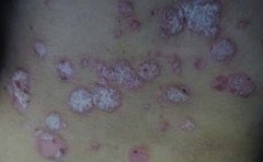 牛皮癣患者用水时有什么注意事项