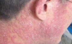 银屑病患者如何防止瘙痒呢