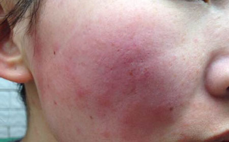 牛皮癣的症状图片