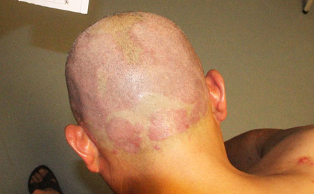 牛皮癣护理方法