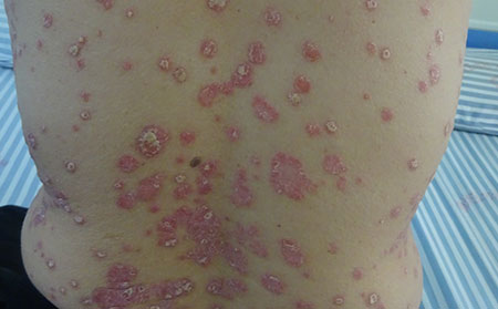 牛皮癣护理方法