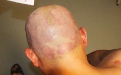 少养宠物保持卫生能够预防牛皮癣复发