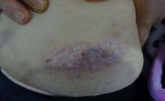 银屑病患者应该怎么饮食才健康