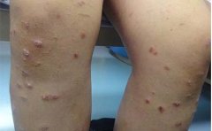 寻常型银屑病在日常护理中应注意哪些问题