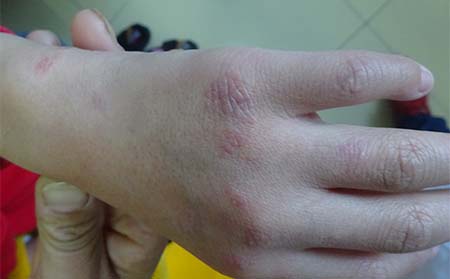 银屑病的症状有什么