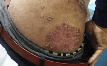 牛皮癣的治疗方法