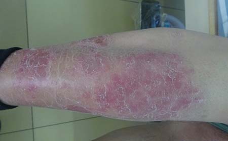 牛皮癣的症状有什么