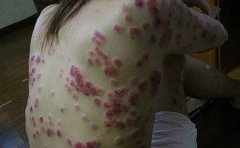 如何正确面对牛皮癣的护理