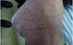 抽烟对银屑病患者有影响吗