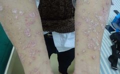 银屑病患者应该注意的事项