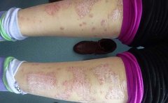 银屑病护理注意点有什么