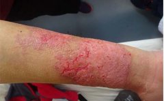 银屑病应该如何预防复发呢