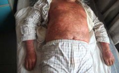 预防银屑病我们需做好哪些工作