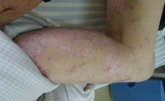 银屑病有哪些症状图片