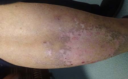 男性银屑病症状,男性银屑病发病症状