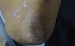 产生牛皮癣的症状是什么