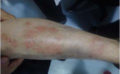 牛皮癣快好的症状是什么