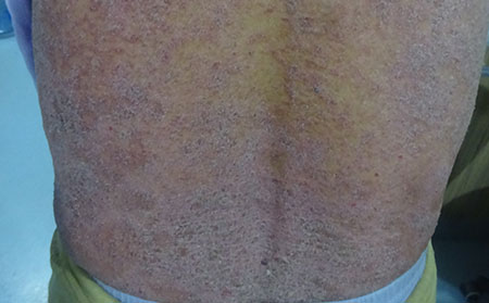 银屑病病因,皮肤银屑病病因