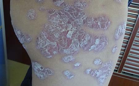 临沂治疗银屑病,临沂哪里治银屑病好