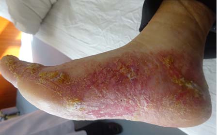 关节型牛皮癣症状,初期关节型牛皮癣表现