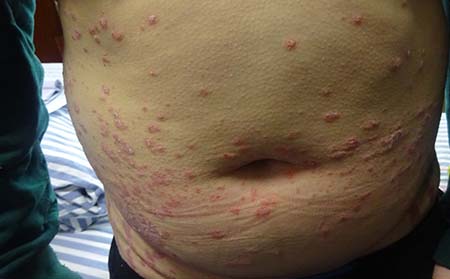 寻常型牛皮癣症状,寻常型牛皮癣表现症状