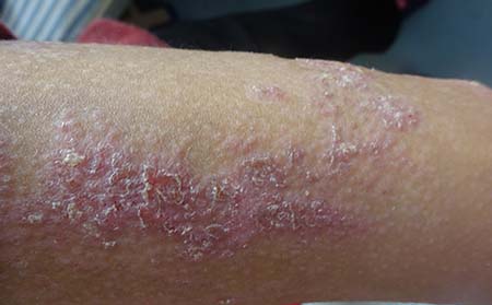 牛皮癣症状表现,牛皮癣扩散什么表现