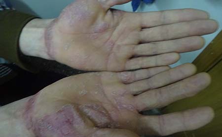 初期牛皮癣症状,牛皮癣初期的症状