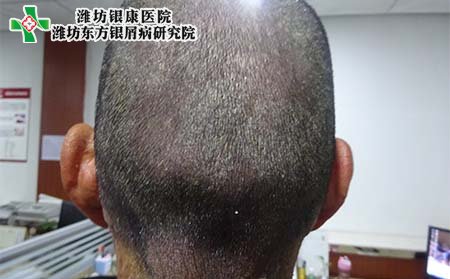 牛皮癣症状表现,牛皮癣症状特征