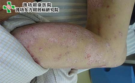 腿部银屑病症状,腿部银屑病症状什么样