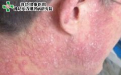 哪些人群容易患上牛皮癣