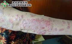 银屑病发病机制及病理