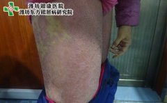 夏季银屑病症状图片