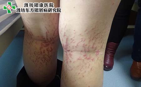 寻常型银屑病表现,寻常型银屑病病理