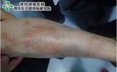 牛皮癣的易发人群有什么