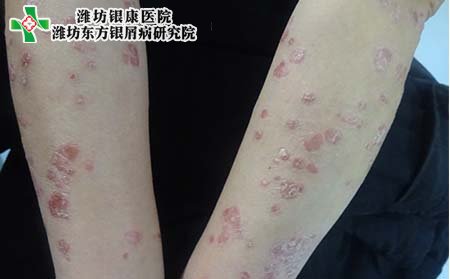 儿童银屑病症状,小孩银屑病临床症状