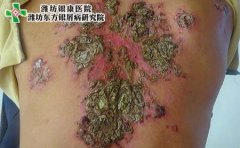 脓疱型银屑病有哪些临床表现