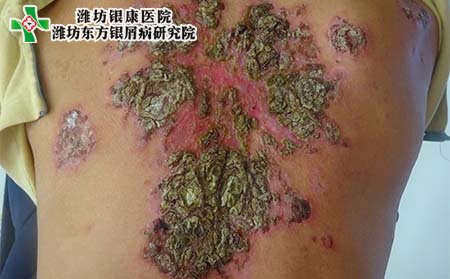 脓疱型银屑病症状,脓疱型银屑病临床表现