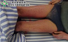 易患牛皮癣的几大人群