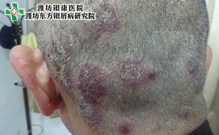 头部银屑病治疗,头部有银屑病怎样治