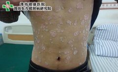 老年人得了牛皮癣怎么办