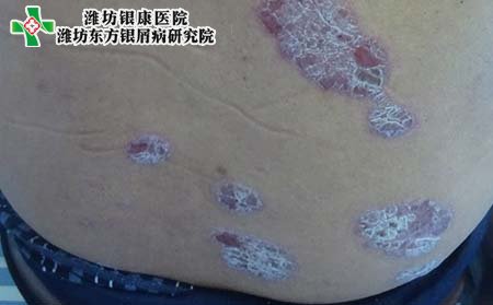 斑块型银屑病症状,斑块型银屑病什么样