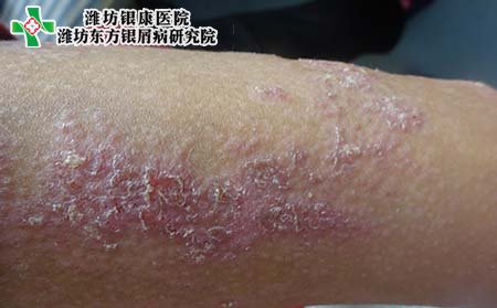 儿童牛皮癣症状,初期小孩牛皮癣症状