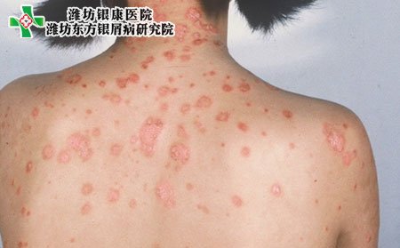 儿童牛皮癣病因,儿童为什么得上牛皮癣