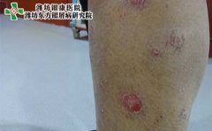 年轻人牛皮癣的病因