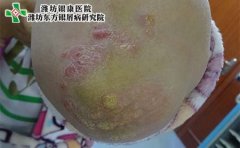 怎样治疗牛皮癣效果好呢