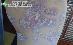 银屑病的基本临床症状