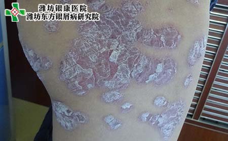 银屑病基本症状,银屑病临床症状表现