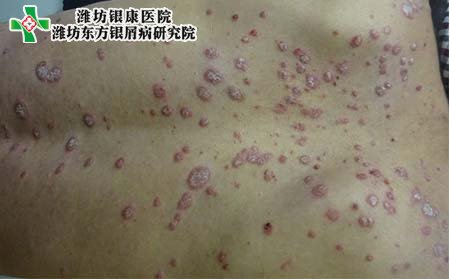 背部银屑病注意,背部得银屑病注意