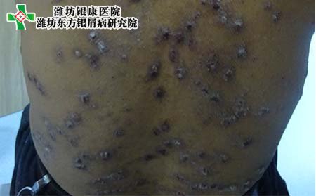 背部银屑病症状,背部银屑病有什么表现