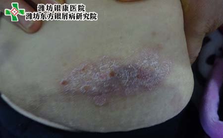 常见牛皮癣症状,牛皮癣常见症状表现